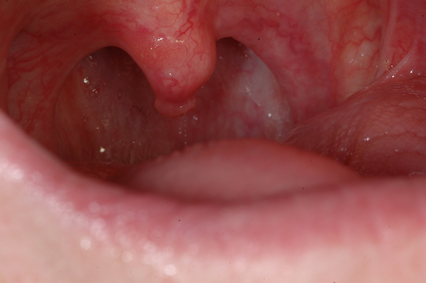 papilloma virus bocca sintomi)