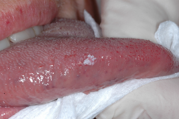 lingua da papilloma virus