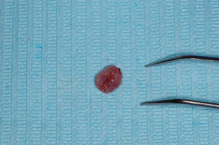Papilloma squamoso della lingua, Papilloma virus test sangue