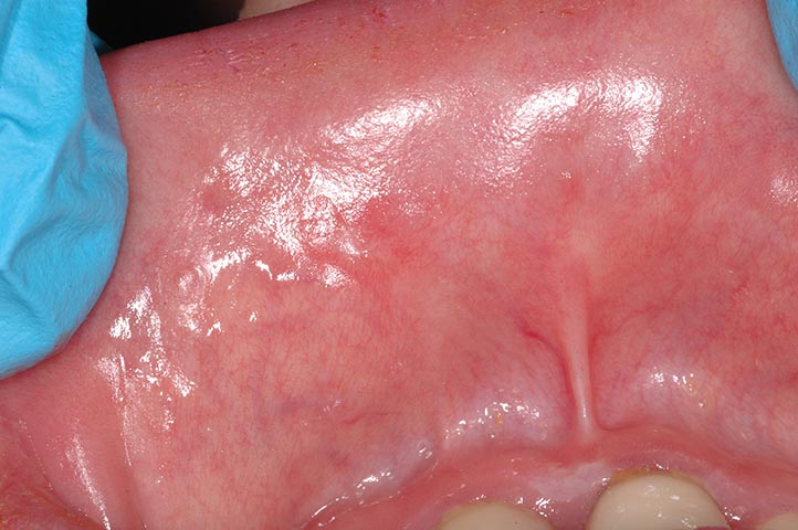 Papilloma virus palato