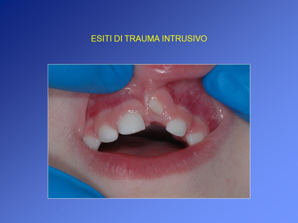 125 Bavaglini Dentali Pediatrici Monouso 45x33 Cm - Cartoon Impermeabili A 3 Strati - Forniture Per Studio Dentistico E Casa